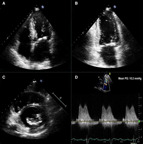 Mitral