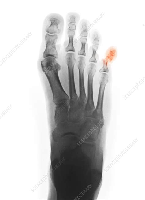 X-ray Showing Fractured Pinky Toe - Stock Image - C012/4077 - Science Photo Library