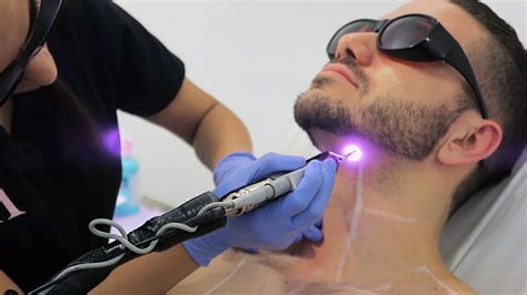 مركز الورود الطبى » LASER HAIR REMOVAL FOR MALE