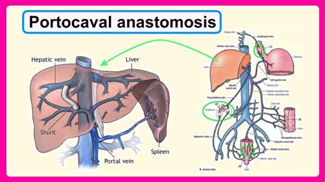 Portacaval Anastomosis