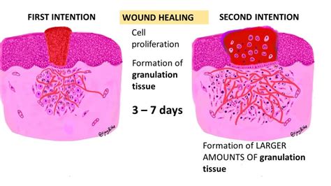 TISSUE REPAIR: Wound Healing - Pathology Made Simple