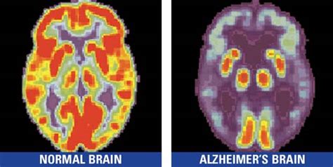 Advanced Imaging Can Foreshadow Alzheimer’s Disease