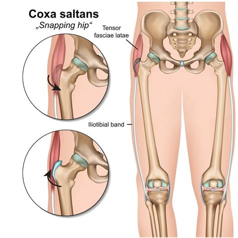 8 Exercises For Snapping Hip Syndrome - Feel Good Life