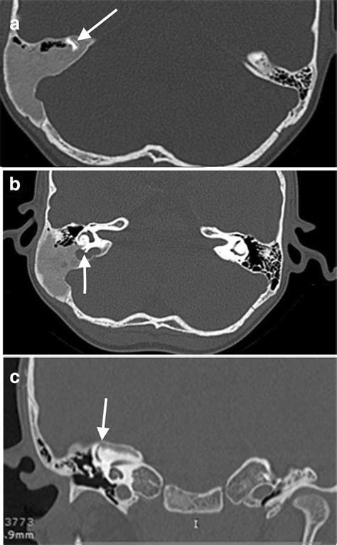 a Coronal CT scan shows involvement of the petrous part of the right ...