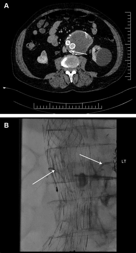 Type II endoleak demonstrated by (A) contrastenhanced computed ...