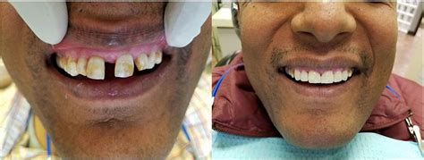 Before & After Gallery — Fit To Smile Dental - Aurora