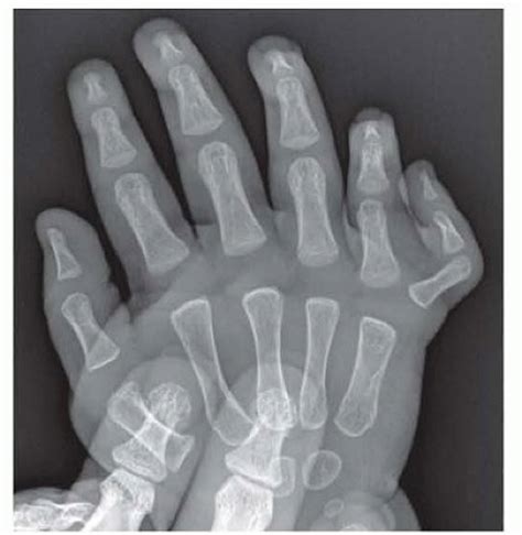 Preaxial and Postaxial Polydactyly | Musculoskeletal Key