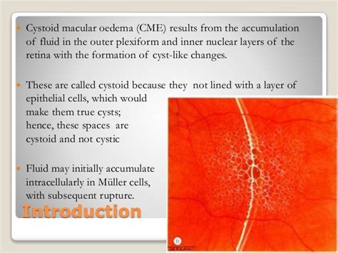 Cystoid macular oedema