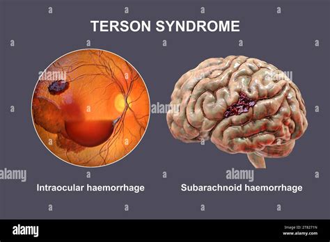 Terson syndrome, illustration Stock Photo - Alamy