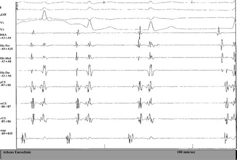 During isoproterenol-induced atrial ectopy, the potential clearly... | Download Scientific Diagram