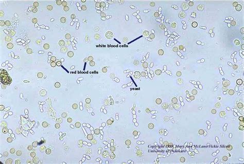 URINE ANALYSIS-NORMAL AND ABNORMAL FINDINGS)