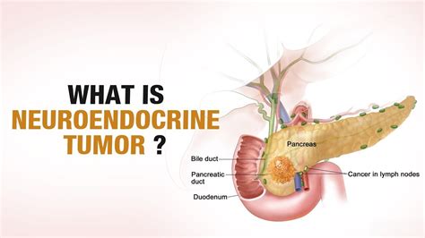 Neuroendocrine tumor (Carcinoid Cancer) – Dr Faisal Dar