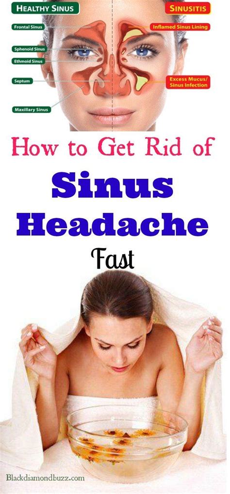 7 Home Remedies for Sinus Headache Fast Relief.... Sinusitis occurs ...