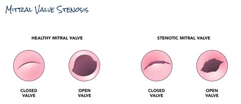 Mitral Valve Stenosis | SCAI - Seconds Count