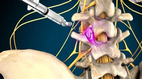 Thoracic Facet Joint Block | Addison Pain & Regenerative Medicine ...