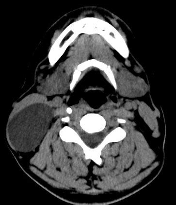 Branchial cleft cyst-CT - Sumer's Radiology Blog