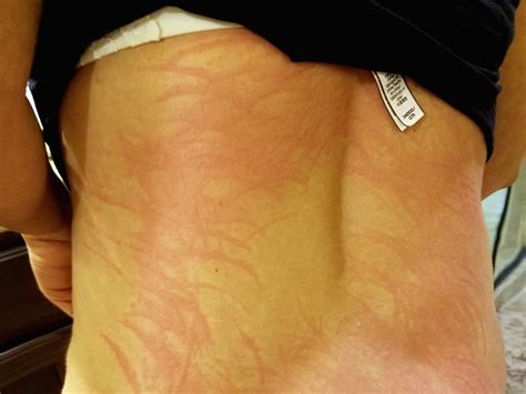 Living with Dermatographia- Skin Condition #4 - Life of Alley