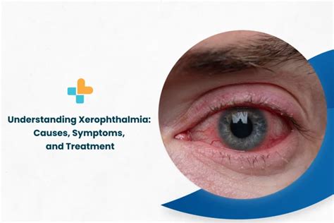 Understanding Xerophthalmia: Causes, Symptoms, And Treatment