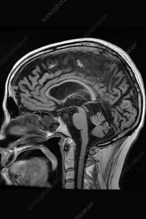 Cerebral atrophy, MRI - Stock Image - C044/8804 - Science Photo Library