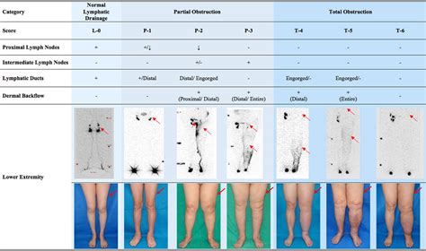 Stages Of Edema Chart