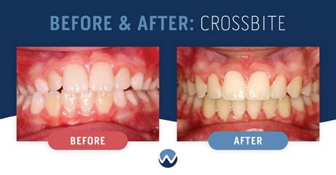 What's a Crossbite? 3 Case Studies Show How We Can Help • Woodhill ...