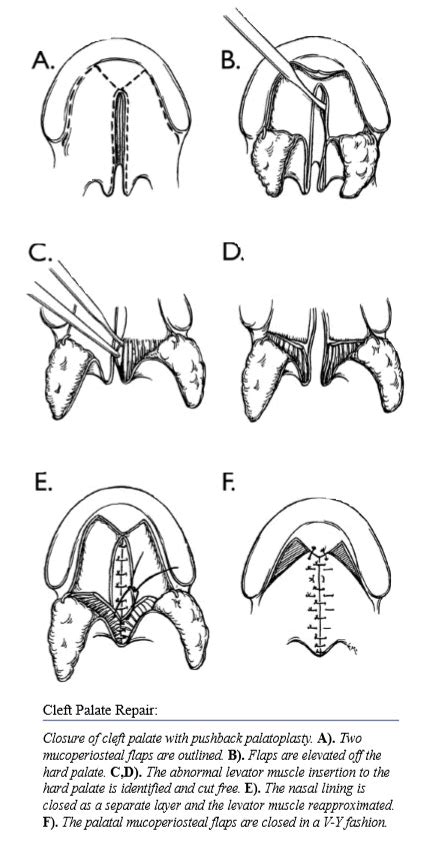 Cleft Palate Repair