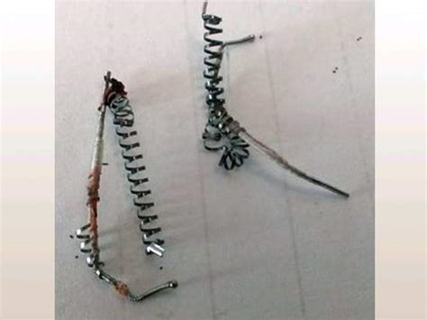 Essure Coils