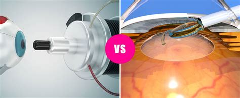 Difference Between LASIK and Intraocular Lenses (IOL) Implant