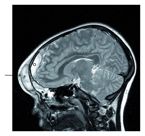 Sagittal MRI demonstrating an abscess within the frontal scalp (arrow)... | Download Scientific ...