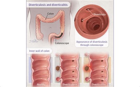 DIVERTICULOSIS and DIVERTICULITIS | Evergreen Family Health