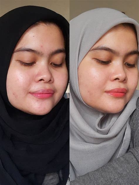 Day 1 vs 7 Differin. : r/tretinoin