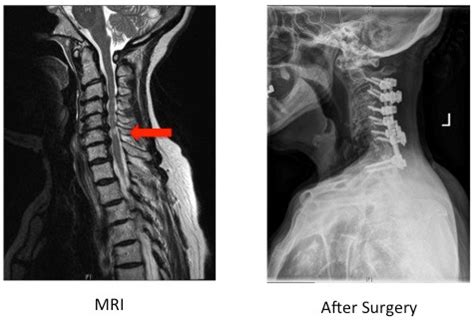 Posterior Cervical Laminectomy and Instrumented Fusion - Samuel K. Cho, MD