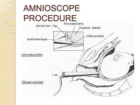 AMINOSCOPY AND FETOSCOPY INVASIVE PROCEDURE.pptx | Free Download