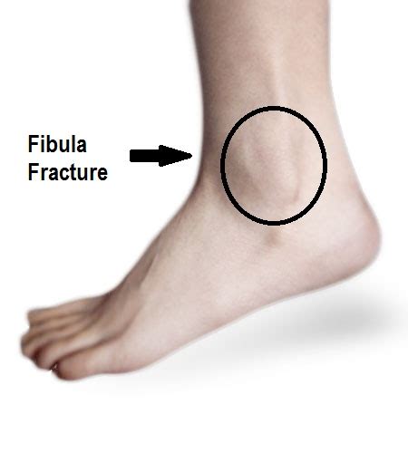 Weber A fracture · Virtual Fracture Clinic