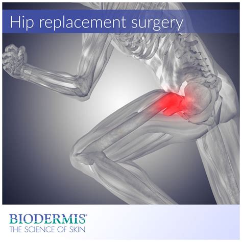 Hip Replacement Surgery and Scar Management | Biodermis.com