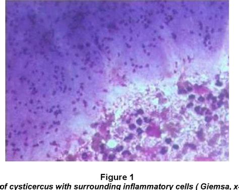 Figure 1 from "ROLE OF FINE NEEDLE ASPIRATION CYTOLOGY IN DIAGNOSIS OF SUBCUTANEOUS ...