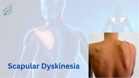 Best Scapular Dyskinesis Treatment | Spinalogy Clinic | Best Back Pain, Slip Disc, Knee ...