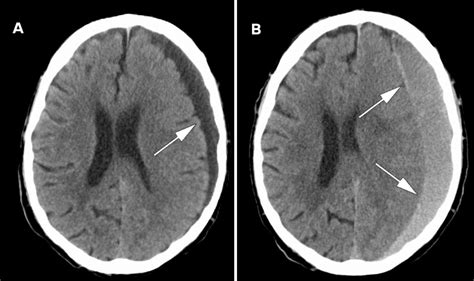 Subdural Hemorrhage CT Scan