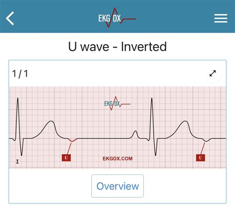 1/ Let’s talk about U waves #CardioTwitter. The U wave is a deflection ...