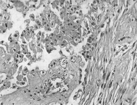 Figure 4 from Hypernephroma and Spindle-Cell Sarcoma of the Kidney | Semantic Scholar