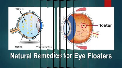 Natural Remedies for Eye Floaters - YouTube