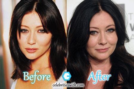 Shannen Doherty Plastic Surgery: Before After Fillers Pictures ...