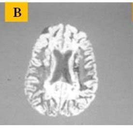 MRI Segmentation into Gray Matter, White Matter and Cerebrospinal Fluid... | Download Scientific ...