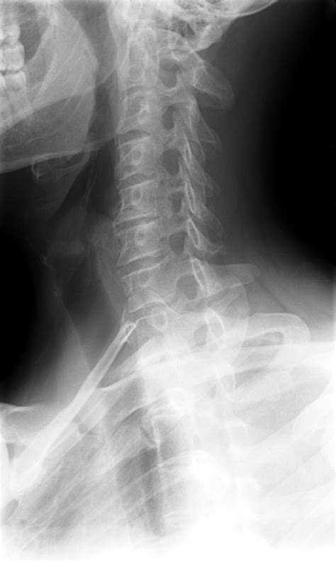 Cervical spine x ray down-s syndrome - onlyfess