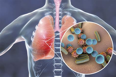 Bacterial Pneumonia in People with COPD