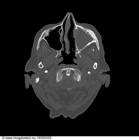 CT of Chronic Maxillary Sinusitis CT of Chronic Maxillary Sinusitis,angiogram,axial,axial cross ...