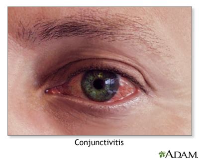 Allergic conjunctivitis Information | Mount Sinai - New York