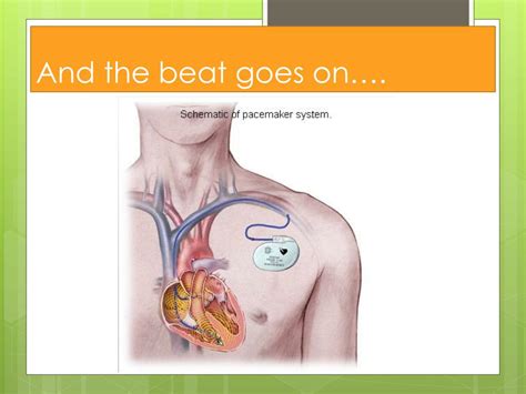 PPT - AICD and Pacemaker Update PowerPoint Presentation, free download ...