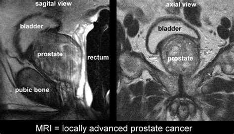 Prostate Anatomy Mri