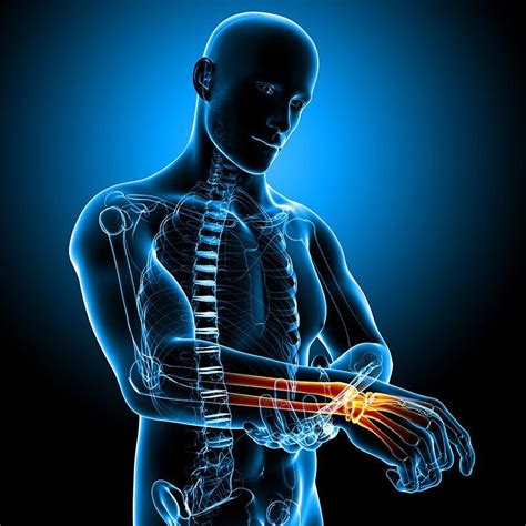 Physical Therapist's Guide to Wrist Fracture